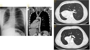 A) Radiografía de tórax que muestra una silueta cardíaca de disposición derecha, con hiperinsuflación y herniación del pulmón izquierdo ocupando ambos hemitórax. B) TAC de tórax con contraste i.v. (corte coronal) donde se objetiva permeabilidad vascular, identificándose el bronquio principal izquierdo (*) interpuesto entre la arteria pulmonar y la aorta. C y D) TAC con contraste i.v. con ventana de parénquima (cortes axiales) que muestra rotación antihoraria de estructuras mediastínicas que se desplazan a la derecha disponiéndose en un plano posterior, hiperinsuflación pulmonar izquierda con herniación derecha y bronquio principal izquierdo (*) discurriendo entre la arteria pulmonar izquierda y la aorta descendente, sin datos de compresión extrínseca y manteniendo un calibre adecuado.