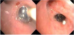 Left: confirmation of air leak with balloon in the segmental bronchus of the upper lobe. Right: the Spiration® IBV valve placed in the posterior bronchus of the right upper lobe.