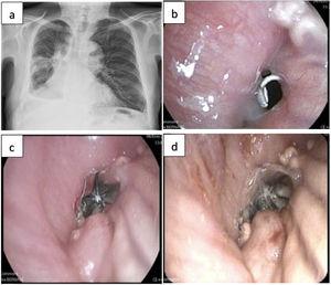 (a) Posteroanterior chest X-ray showing post-surgical changes, right hydropneumothorax with air-fluid level at the most basal part of the right hemithorax and right pleural effusion; (b) endoscopic view of the fistula orifice in the central area of the right lower bilobectomy stump; (c) endoscopic view after implantation in the fistula orifice of the 9mm Spiration® Olympus intrabronchial valve; and (d) intrabronchial valve implanted in the fistula orifice after instillation of platelet-rich plasma. Note the surrounding granulation tissue.