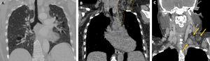 Coronal chest CT scan (A) in mediastinal window demonstrates multiple parenchimal cystic lesions. Coronal chest (B) and neck (C) CT scans show multiple hamartomatous lesions (circle and arrows) with complex lipid density.