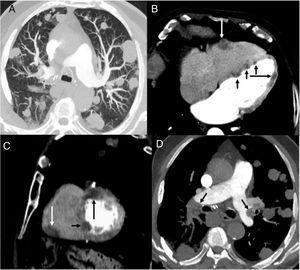 (A) Axial CT image of the chest (lung parenchyma window), showing multiple bilateral pulmonary nodules. (B and C) Axial (B) and sagittal (C) chest CT images (mediastinal window) showing several nodules in the right ventricular free wall (white arrow), interventricular septum (short black arrows) and left ventricular free wall (long black arrow). (D) Axial CT image of the chest (mediastinum window) showing filling defects in the pulmonary arteries (arrows).