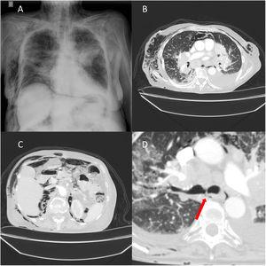 (A) Plain chest X-ray with left parahilar mass and interstitial pattern consistent with bilateral lymphangitis. Significant subcutaneous emphysema can be observed at the cervical and costal level. Pneumomediastinum is also identified around the cardiac silhouette and pneumoperitoneum in the right hemidiaphragm. (B) Computed tomography of the chest (lung window) showing pneumomediastinum, pneumopericardium, and subcutaneous emphysema, in addition to the previously identified tumors and left pleural effusion. (C) Computed tomography of the abdomen (lung window) showing pneumoperitoneum, retropneumoperitoneum, and subcutaneous emphysema. (D) Computed tomography of the chest (lung window) showing a fistula in the posterior wall of the right main bronchus (arrow).
