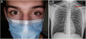 (A) Eyelid ptosis and myosis of the left eye. (B) Chest X-ray: the tip of the pleural drainage tube is seen at the left lung apex (red arrow).
