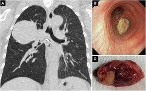 Coronal thoracic CT section (A) shows a 110mm×80mm solid mass lesion located in the right hilar and invading the main bronchus (arrow). Flexible bronchoscopy shows a polypoid type endobronchial lesion protruding from the right main bronchus entrance to the trachea (B). Spontaneously expectorated tumor tissue of 33mm×20mm×14mm is seen macroscopically (C).