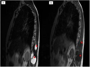 MRI reports the presence of two intramuscular myxomas (IM) hypointense on T1 (B) and hyperintense on T2 (A).
