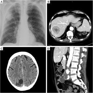 (A) Chest X-ray showing a mass in the right upper lobe; (B) hepatic nodule identified in the abdominal CT scan; (C) cranioencephalic CT scan with the presence of a nodule in the occipital area, with vasogenic oedema; (D) abdominal CT scan showing a thrombosed aneurysm in the abdominal aorta.