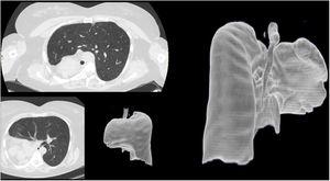 Computed tomography revealed complete agenesis of the right lung with compensatory hyperinsuflation of the left lung.