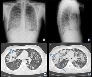 Simple chest X-ray in AP (A) and lateral (B) projections, showing bilateral domain infiltrates in the middle and lower lung fields. Chest CT without IV contrast, lung parenchyma window and axial slices (C and D). We identify patchy pulmonary opacities centered on centrilobular bronchioles, which become confluent forming alveolar parenchymal consolidations with air bronchogram, diffusely distributed in both hemithorax although with dominance in the middle and lower lungs fields. In some areas, centrilobular nodules and “tree-in-bud” images are observed (thin arrow).