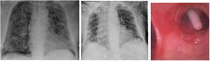 (A) X-ray that shows a pneumothorax. (B) X-ray with a misplaced drainage. (C) A pleural drainage located in the lumen of 10th segment of right lower lobe.
