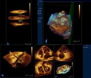 Planos ecocardiográficos tridimensionales espaciales para el análisis de la aurícula izquierda y el área de la válvula mitral.