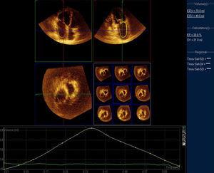 Volúmenes ecocardiográficos tridimensionales máximo (70 ml) y mínimo (49 ml) de la aurícula izquierda y su fracción de vaciado (30%) en un paciente con estenosis de válvula mitral.