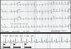 A: electrocardiograma de 12 derivaciones de la taquicardia. El tercero y el cuarto complejo QRS se preceden de una onda P. Este fenómeno puede observarse luego cada dos complejos QRS, por lo que, de hecho, se trata de un ritmo sinusal normal con un PP de 830 ms (73 lpm) y una doble respuesta ventricular, que conduce a una taquicardia con un RR de 350-390 ms (154-171 lpm). El PR1 era de 150 ms y el PR2, ligeramente irregular, entre 560 y 610 ms. Puede observarse una relación fija clara. La primera onda P (*) es un latido supraventricular seguido de un QRS, probablemente a causa de un bloqueo de conducción anterógrado en la vía lenta, y el cuarto QRS muestra una aberrancia (fenómeno de Ashman). B: detalle de la tira de ritmo de la derivación II. Se puede apreciar claramente las ondas P.