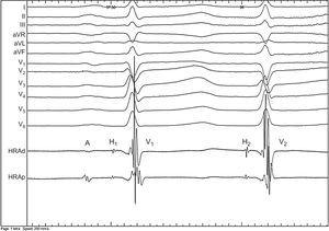 Electrocardiograma de 12 derivaciones con registros intracardiacos con el catéter en el His que muestran dos potenciales de His y dos potenciales de V tras un A con el mismo intervalo HV (AH1, 110 ms; H1V1 43 ms; AH2 629 ms; H2V2 43 ms).