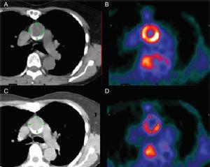 Imágenes de tomografía computarizada (A y C) y tomografía por emisión de positrones (B y D) de la aorta torácica ascendente antes (A y B) y durante el tratamiento antiaterosclerótico (C y D). Nótese la marcada reducción en la captación de 18-fluorodesoxiglucosa. Tomadas de Rudd et al69, con permiso del propietario del copyright. Esta figura se muestra a todo color solo en la versión electrónica del artículo.
