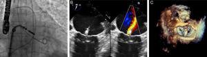 Imágenes que muestran un dispositivo MitraClip® durante el proceso de implante. A: angiografía. B: ecocardiografía transesofágica bidimensional. C: ecocardiografía transesofágica tridimensional.
