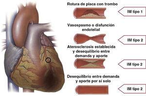 Diferenciación entre infarto de miocardio (IM) tipos 1 y 2 según el estado de las arterias coronarias.