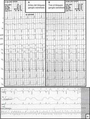 Electrocardiograma antes (A) y después (B) del bloqueo del ganglio simpático en el que se comprueba la reducción no significativa del QTc. C: ejemplo de inicio de taquicardia ventricular sostenida.