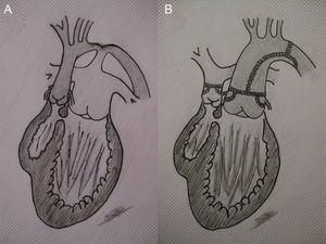 A: ventrículo izquierdo conectado con arteria pulmonar (hiperaflujo) y ventrículo derecho (rudimentario) conectado con aorta (fisiología univentricular con transposición de grandes arterias); comunicación interventricular restrictiva (estenosis subaórtica) y coartación aórtica. B: reparación del arco más switch paliativo, conectando ventrículo izquierdo con neoaorta y creando una estenosis subpulmonar (flujo pulmonar regulado por la comunicación interventricular restrictiva).