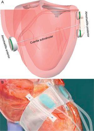 Dispositivos de remodelado ventricular. A: iCoapsys. B: Mardil-BACE. Modificada de Pedersen et al55, con permiso.