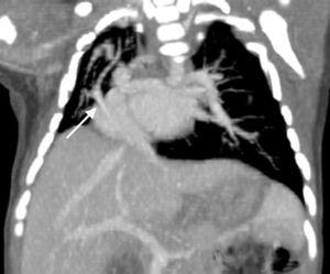 Angiografía por tomografía computarizada de un varón de 1 mes de edad, con síndrome de la cimitarra asintomático. Obsérvese el drenaje venoso pulmonar anómalo (flecha), la hipoplasia del pulmón derecho, la dextrocardia y el pulmón en herradura.