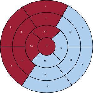 Mapa polar de 17 segmentos en el que se diferencia el territorio anterior (fondo granate) del inferolateral (fondo azul). Segmentos: 1, basal anterior; 2, basal anteroseptal; 3, basal inferoseptal; 4, basal inferior; 5, basal inferolateral; 6, basal anterolateral; 7, medio anterior; 8, medio anteroseptal; 9, medio inferoseptal; 10, medio inferior; 11, medio inferolateral; 12, medio anterolateral; 13, apical anterior; 14, apical septal; 15, apical inferior; 16, apical lateral y 17, ápex. Esta figura se muestra a todo color solo en la versión electrónica del artículo.