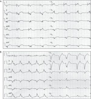 Electrocardiograma de 12 derivaciones al inicio (A) y en el primer minuto del test de esfuerzo (B) de una paciente en fibrilación auricular permanente.