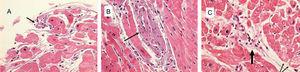 Biopsia endomiocárdica de ventrículo izquierdo (Masson, ×40) que muestra una necrosis de fibras miocárdicas (A, flecha) con un infiltrado de células inflamatorias y un marcado edema intersticial que causa una separación de las fibras (A), infiltrado inflamatorio perivascular (flecha) con una fibra necrótica (B) e infiltrado linfocitario perivascular (C, flecha gruesa), y vacuolización de las fibras miocárdicas correspondiente a un edema celular (C, flechas finas).