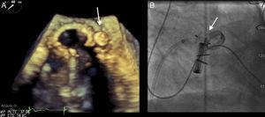 Dispositivo implantado (flecha) en fuga perivalvular de un paciente portador de prótesis mitral y aórtica. A: imagen ecocardiográfica tridimensional. B: imagen angiográfica.
