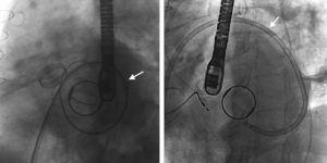 Imágenes angiográficas del catéter dirigible (Agilis, St. Jude Medical) (flecha) utilizado para punción transeptal y abordaje de las fugas periprotésicas.