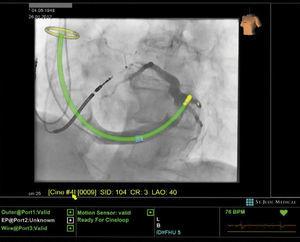 Imagen de MediguideTM Technology durante implante de resincronizador cardiaco. Reproducido con permiso de St. Jude Medical, 2013.