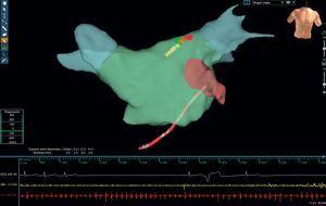 Reconstrucción anatómica de la aurícula izquierda con sistema de navegación Ensite-NavX®. Durante la aplicación de radiofrecuencia a la zona del ganglión superior izquierdo (lesiones marcadas en rojo) en un paciente con fibrilación auricular persistente, se puede observar una respuesta vagal con pausa nodular significativa. Esta figura se muestra a todo color solo en la versión electrónica del artículo.