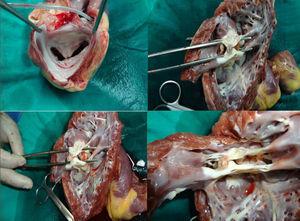 Clip mitral de un paciente que requirió trasplante cardiaco 6 meses después del implante del dispositivo.