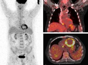 Tomografía por emisión de positrones volumétrica de cuerpo entero e imágenes coronal y axial de fusión de la tomografía por emisión de positrones-tomografía computarizada.