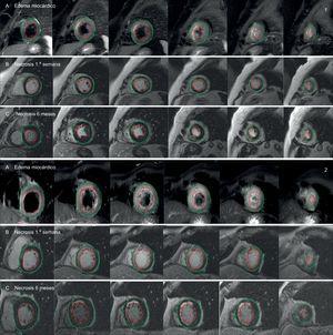 Comparación de estudios de resonancia magnética cardiaca entre dos pacientes paradigmáticos según la inducción de PGC-1α tras infarto de miocardio (1: paciente con inducción; 2: paciente sin inducción): área en riesgo estimada por edema miocárdico en secuencias T2-weighted Short Tau Inversion Recovery (T2-STIR) (A), y área de necrosis estimada por realce tardío de gadolinio durante la primera semana (B) y a los 6 meses (C). Las áreas de necrosis y edema (líneas de color granate) se calcularon con respecto a la masa miocárdica total, trazando manualmente los contornos epicárdico (línea verde) y endocárdico (línea roja). Esta figura se muestra a todo color solo en la versión electrónica del artículo.