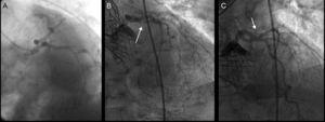 A: coronariografía previa al implante transcatéter de prótesis aórtica. B y C: estenosis angiográficamente significativa en arteria circunfleja proximal.