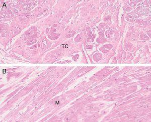 Tinción de hematoxilina-eosina de falso tendón del ventrículo izquierdo a 10 (A) y 20 aumentos (B), que muestra predominio de tejido muscular, si bien se observa también tejido conectivo. M: muscular; TC: tejido conectivo.