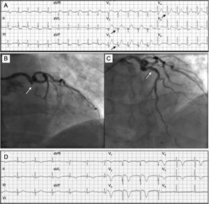 A: electrocardiograma a los 120min de iniciarse el dolor, con «complejos de De Winter» V2-V5 (flechas). B: oclusión de la descendente anterior proximal (flecha). C: restauración del flujo en la descendente anterior tras angioplastia e implante de stent (flecha). D: electrocardiograma tras el procedimiento; imagen de infarto anterior en evolución, con ondas Q en V1-V3, mínimo ascenso del ST y negativización de la onda T en V1-V5.
