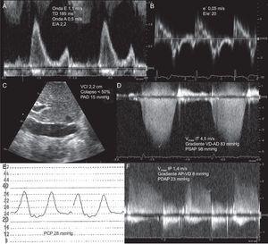 Estimación de presiones de llenado izquierdas mediante ecocardiografía Doppler en un paciente con disnea y función ventricular izquierda normal. A: Doppler-pulsado de llenado mitral que muestra un patrón de llenado restrictivo. B: Doppler tisular del anillo mitral lateral que permite estimar una relación E/e’ > 15. C: plano subcostal de la vena cava inferior. D: Doppler continuo de regurgitación tricuspídea y estimación de la presión sistólica pulmonar. E: señal de presión capilar pulmonar obtenida con catéter de Swan-Ganz. F y G: Doppler de regurgitación pulmonar y estimación de la presión diastólica pulmonar. AD: aurícula derecha; AP: arteria pulmonar; IP: insuficiencia pulmonar; IT: insuficiencia tricuspídea; PAD: presión auricular derecha; PCP: presión capilar pulmonar; PDAP: presión diastólica en arteria pulmonar; PSAP: presión sistólica en arteria pulmonar; TD: tiempo de deceleración de llenado precoz mitral; VCI: vena cava inferior; VD: ventrículo derecho: Vmáx: velocidad máxima. Onda A: velocidad de llenado auricular mitral. Onda E: velocidad máxima del llenado precoz mitral. Onda e’: velocidad protodiastólica del anillo mitral lateral.