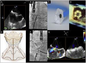 A: paso de la vaina hasta la aurícula izquierda por la fossa ovalis. B, C y D: imagen angiográfica (B), en banco de pruebas (C) y mediante ecocardiografía 3D (D) de la apertura de la parte izquierda del dispositivo en la aurícula izquierda. E, F y G: imágenes en banco de pruebas (E), angiográfica (F) y ecocardiográfica con Doppler color (G) del dispositivo V-Wave desplegado.