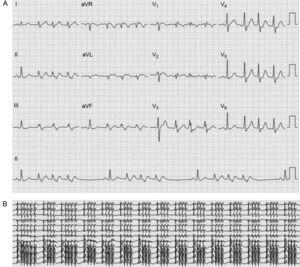 A: electrocardiograma de 12 derivaciones del paciente. B: electrocardiograma de la telemetría.