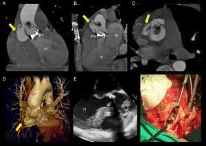Endocarditis sobre prótesis aórtica mecánica con seudoaneurisma en la raíz aórtica. La tomografía computarizada con multidetectores identificó un seudoaneurisma en el seno de Valsalva derecho (flecha amarilla) en los plano coronal (A), sagital (B) y axial (C), y en la reconstrucción tridimensional (D), junto con una gran vegetación anclada en la aorta ascendente proximal (*). En la ecocardiografía transesofágica (E) se visualizó la vegetación, pero no se detectó el seudoaneurisma. Estos hallazgos fueron confirmados durante la cirugía (F). AI: aurícula izquierda; PV: prótesis valvular aórtica mecánica; VI: ventrículo izquierdo.