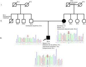 Pedigrí de la familia estudiada junto con los electroferogramas de la región de FBN1que muestran la mutación c.2677+5G>C (flecha). El alelo mutado (citosina, en azul) está presente en menor proporción en la madre que en el índice, lo que sugiere mosaicismo. Esta figura se muestra a todo color solo en la versión electrónica del artículo.