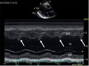 Imagen de registro en modo M de ecografía transtorácica a nivel ventricular izquierdo en eje paraesternal largo. Las flechas verticales señalan la presencia de septal flash, que es un rápido movimiento del septo hacia la cavidad ventricular durante la duración del QRS. PP: pared posterior del ventrículo izquierdo; SIV: septo interventricular; VI: ventrículo izquierdo.