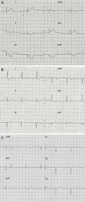 Patrones electrocardiográficos de pacientes incluidos en el estudio. A: descenso especular del segmento ST > 0,1 mV. B: descenso especular de 0,05 mV. C: descenso especular < 0,05 mV y alteración simétrica de la onda T.