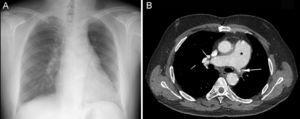 A: radiografía de tórax en la que se observa disminución del volumen del hemitórax izquierdo y ausencia de trama vascular. B: angiotomografía computarizada en la que se aprecia dilatación del tronco común de la arteria pulmonar (asterisco) y oclusión de la arteria pulmonar izquierda (flecha).