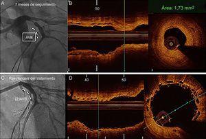 Imágenes de angiografía (A y C) y de tomografía de coherencia óptica de una reestenosis tardía (7 meses) en el margen proximal (B). En la situación inicial, la revascularización de la arteria descendente anterior izquierda se llevó a cabo con un AVB de 3,5 × 18 mm. B: reestenosis en el seguimiento con un tejido homogéneo fuera del armazón. C: resultado final del tratamiento de la reestenosis. D: solapamiento mínimo de los 2 AVB implantados. AVB: armazón vascular bioabsorbible.