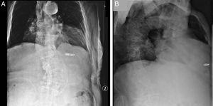 Radiografía posteroanterior (A) y lateral (B) de tórax con la disposición final del dispositivo.