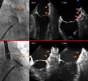 Imágenes radiológicas y ecocardiográficas de los dispositivos Amplatzer Cardiac Plug (flechas) de los pacientes 1 (A) y 2 (B), correctamente posicionados en el implante y sin presencia de trombo en controles ecocardiográficos a las 24 h y al año.