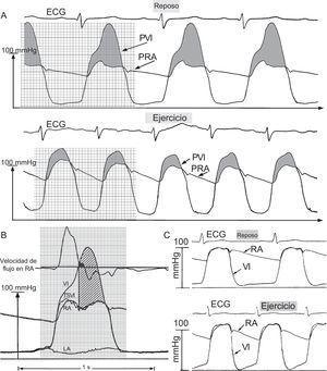A: presión del ventrículo izquierdo (PVI) profundo y de la raíz aórtica (PRA) en la miocardiopatía hipertrófica en reposo y durante el ejercicio de bicicleta en decúbito supino, que provoca una disminución diastólica anormal de la PVI, lo cual indica deterioro de la relajación ventricular; la disminución de la PVI durante toda la diástole contrasta claramente con el patrón normal que se muestra en el panel C. B: relación presión-flujo con altos gradientes dinámicos mesosistólicos y telesistólicos tempranos y enormes en la miocardiopatía hipertrófica; de arriba abajo, señal de velocidad aórtica y señales micromanométricas del ventrículo izquierdo (VI) profundo, el tracto de salida del VI (TSVI) y la raíz aórtica (RA), medidas con un catéter cardiaco izquierdo con multisensores de presión y velocidad retrógrada de triple punta; la señal micromanométrica de la aurícula izquierda (AI) se determinó al mismo tiempo mediante un catéter transeptal; la línea recta vertical identifica el inicio del contacto entre el movimiento sistólico anterior y el tabique, determinado mediante una ecocardiografía de la válvula mitral en modo M simultánea (no mostrada); la mayor parte del flujo de eyección aórtico se ha completado ya en ese momento; el enorme gradiente mesosistólico y telesistólico (área sombreada) se mantienen ante la minúscula velocidad aórtica anterógrada restante o incluso negativa. Adaptado de Pasipoularides3 con permiso de PMPH-USA.