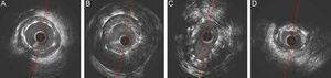 Hallazgos cualitativos en la ecografía intravascular. A: malaposición. B: malaposición + aneurisma. C: infraexpansión. D: placa de neoateroesclerosis calcificada.